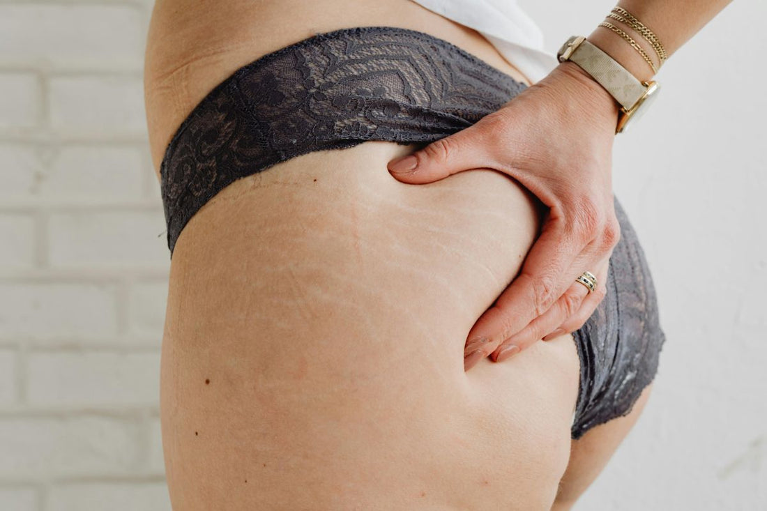 La Cellulite: Cause, Miti e Consigli Nutrizionali per ridurla